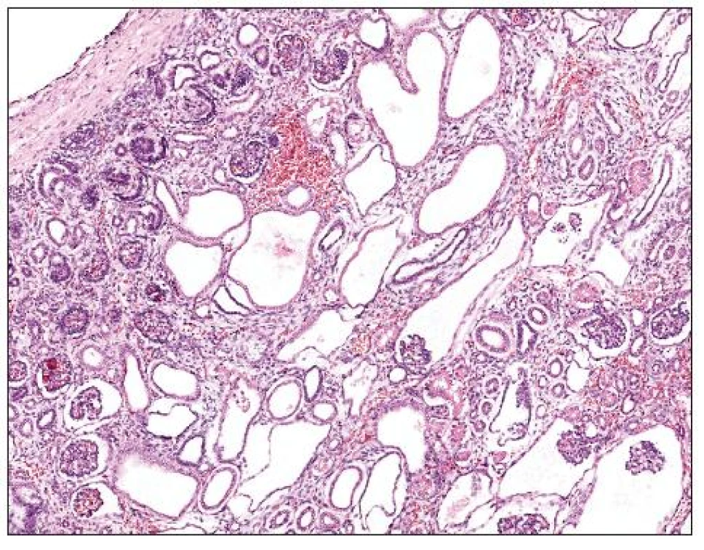 Fetální ledvina s četnými cystami, včetně rozměrných cyst glomerulárních, přehled (HE, 100krát)