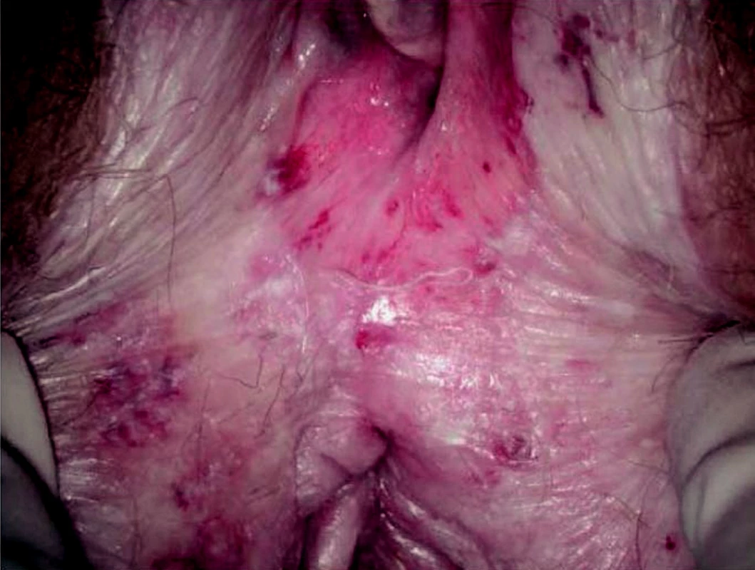 Lichen sclerosus v oblasti zadní komisury vulvy, malých stydkých pysků a perianálně. Ekchymózy, eroze a kožní kryt s texturou celofánu.
