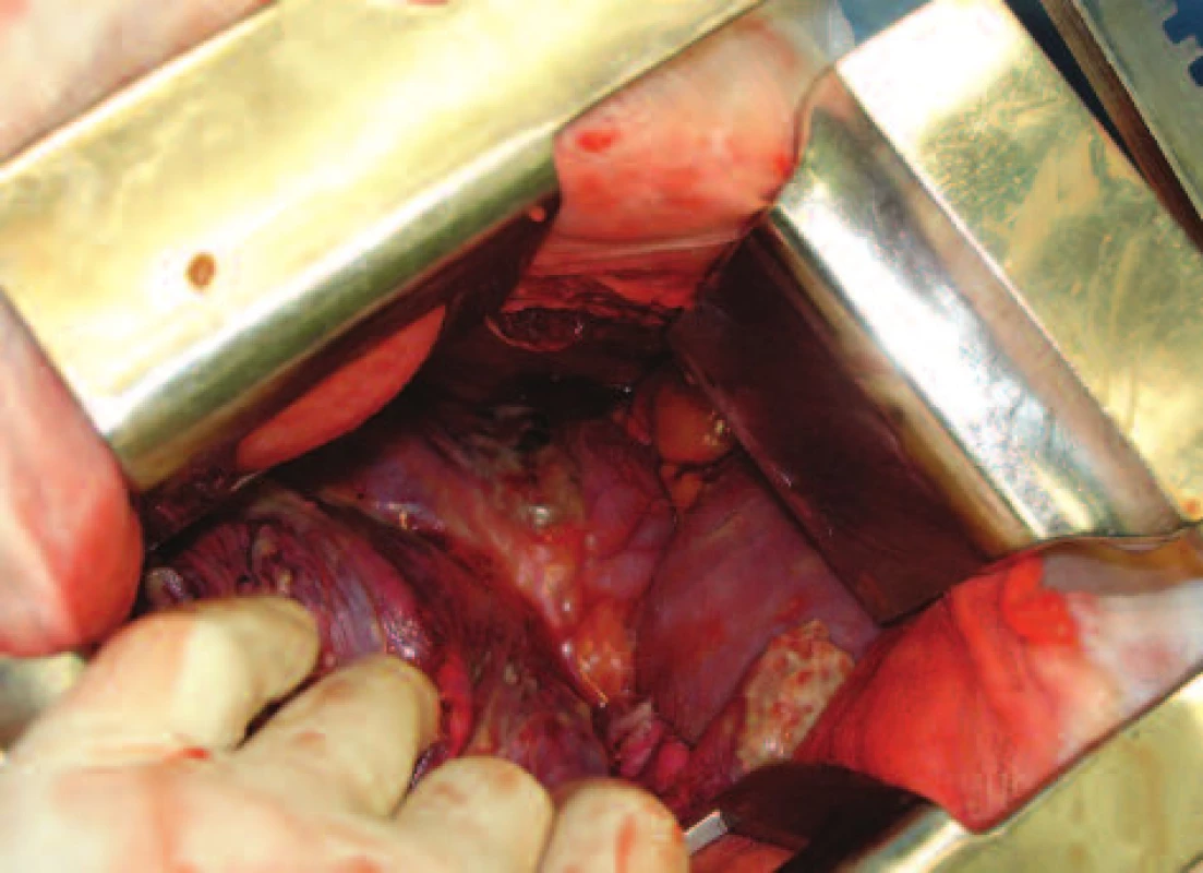 Nekróza v části předního mediastinina, pohled z pravostranné torakotomie
Fig. 5: Necrosis in the anterior mediastinum, view from right-sided thoracotomy