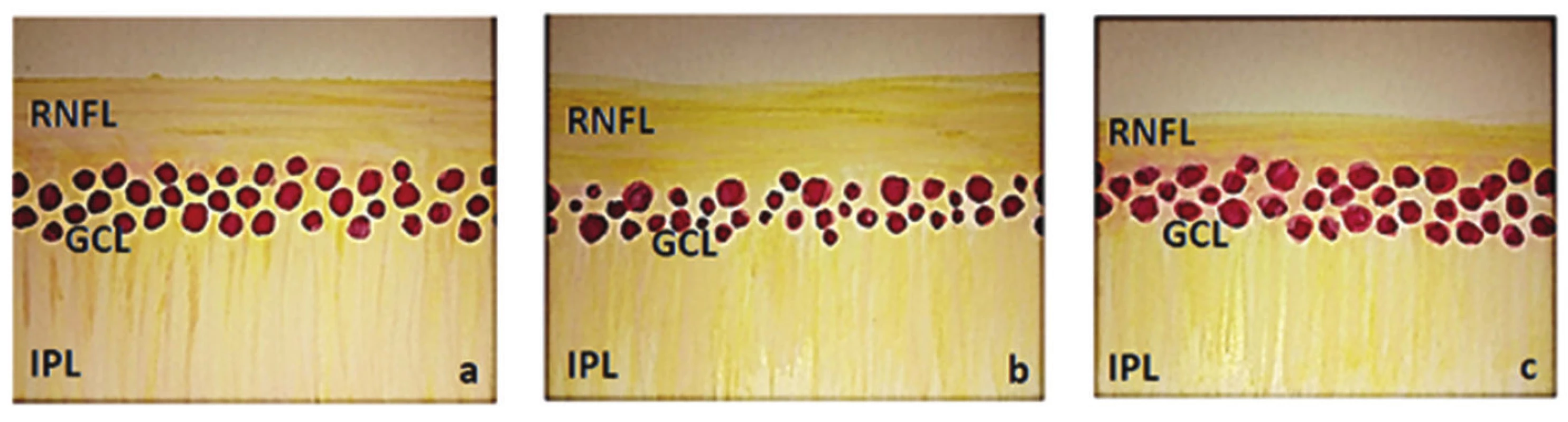 Schematické zobrazení vnitřních vrstev sítnice, (RNFL – vrstva nervových vláken, GCL – vrstva gangliových buněk a IPL – vnitřní plexiformní vrstva)
a) normální nález, b) nález u HTG – snížení vrstvy GCL a nepatrně i RNFL, c) nález u NTG – snížení RNFL a nepatrně i GCL