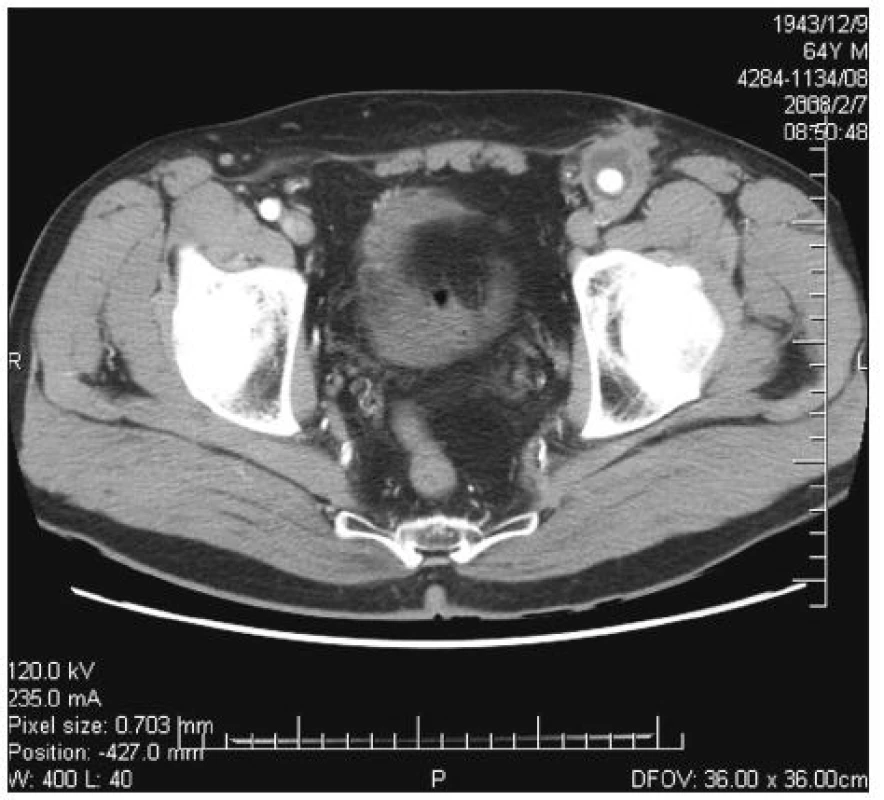 Infekce aorto-femorální cévní protézy vlevo. CT obraz abscesu kolem cévní protézy v oblasti nad tříselným vazem
Fig. 1. Infected left aorto-femoral prosthetic graft. CT image of an abscess around the vascular prosthesis in the suprainguinal area