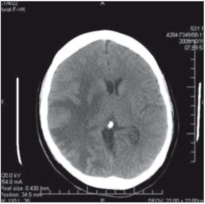 CT mozku: dislokace středočarových struktur o 8 mm a ložiska v temporálním laloku vpravo u pacientky 1.