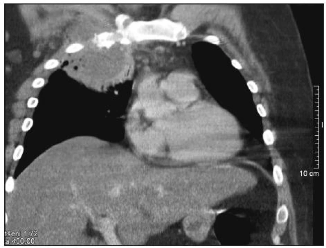 CT scan hrudníku s abscesem při zánětu sternoklavikulárního kloubu (kazuistika č. 2)
Fig. 2. CT scan of the chest (case report No. 2)