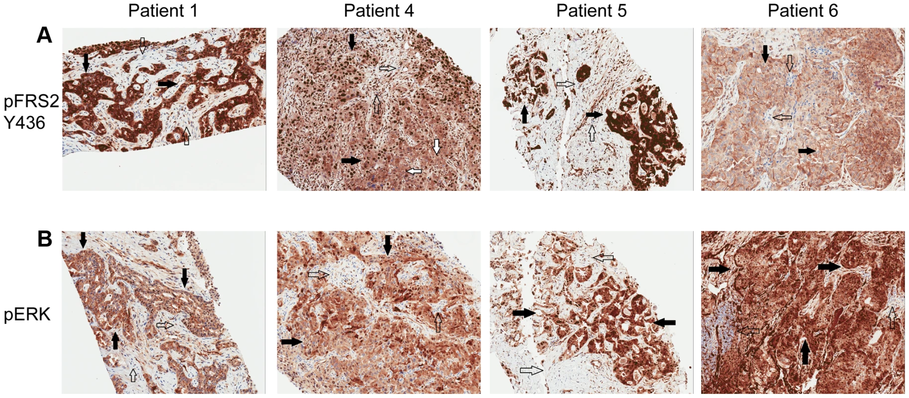 Immunohistochemistry demonstrating pFRS2 Y436, and pERK expression in Patients 1, 4, 5 and 6.