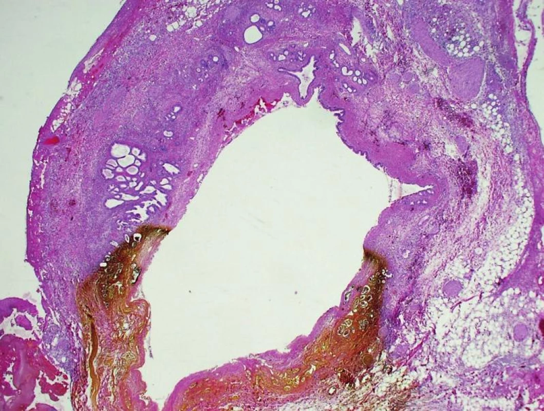 Ischemická nekrosa úseku stěny extrahepatálního žlučovodu, při ERCP se projeví jako leak. Místo nekrosy je prosáklé žlučí.