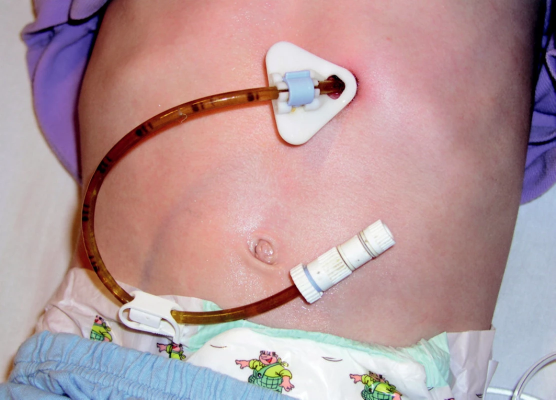 Perkutánní endoskopická gastrostomie – fixace na kůži