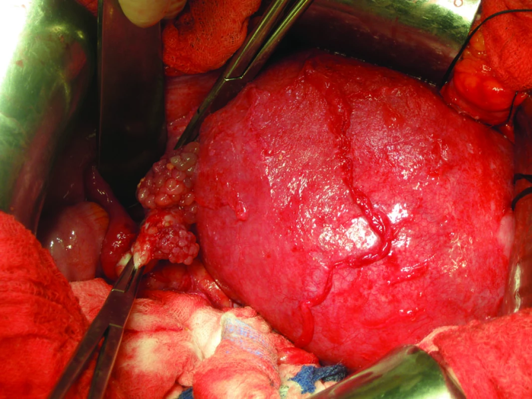 Serózní ovariální borderline tumor (mikroinvazivní subtyp) v 18. týdnu gravidity.