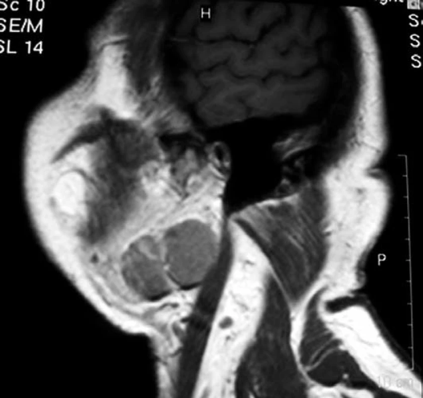 Ohraničené nádorové uzly v dolním pólu levé příušní žlázy (MR)