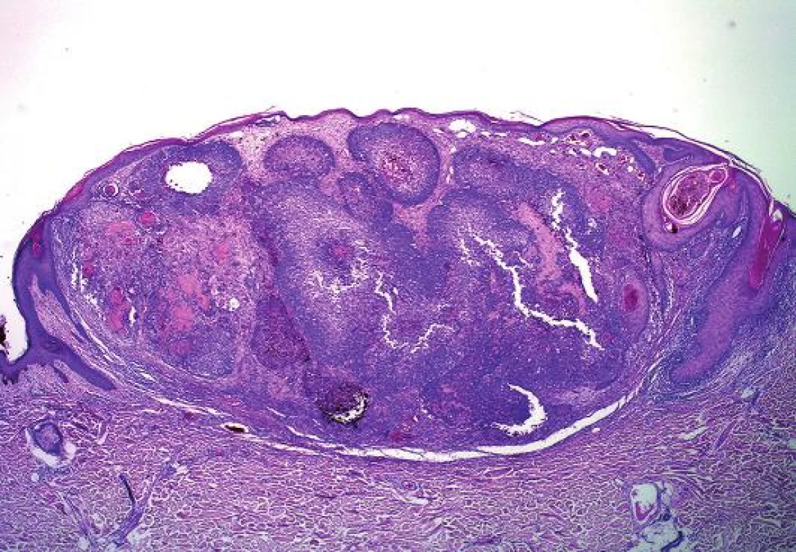 Melanocytární matrikom: solitární nádorový uzel vyklenuje atrofickou epidermis, avšak nesouvisí s ní (HE, původní zvětšení 25x).