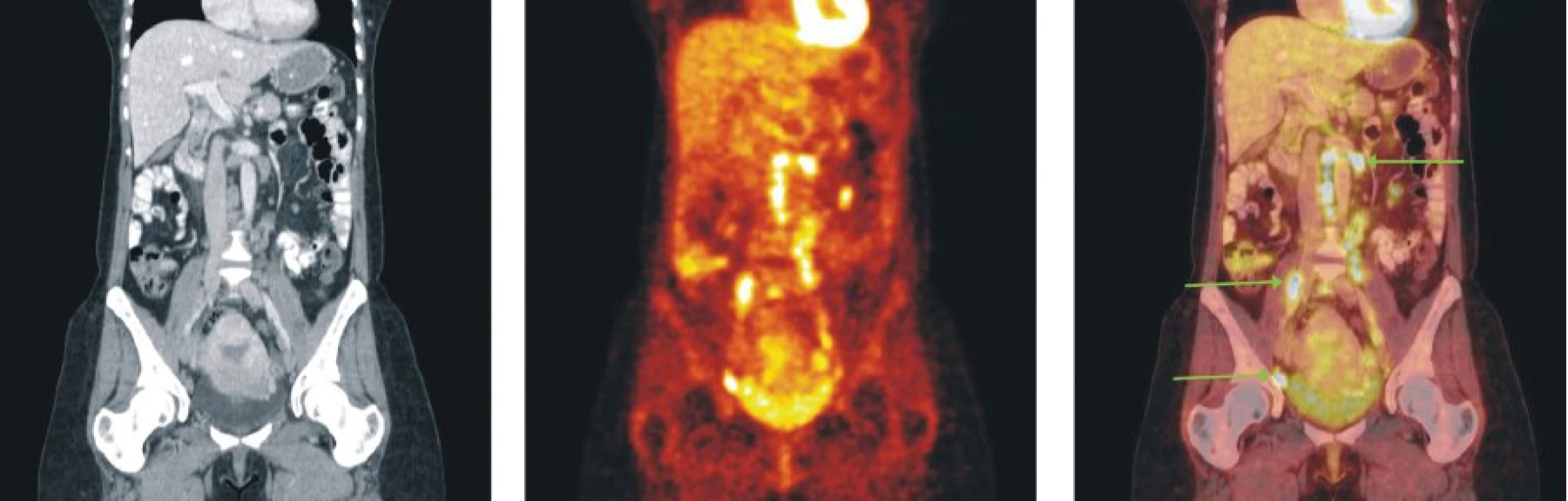 Snímky výpočetní tomografie (CT), pozitronové emisní tomografie (PET) a PET/CT u nemocného s folikulárním lymfomem stupně 2 a postižením lymfatických uzlin retroperitonea, mezenteria a pánve.