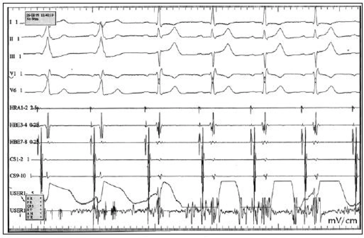 RFA WPW syndromu, akcesorní spojky levé laterální. Během aplikace RF energie, dochází k přerušení vodivosti akcesorní dráhy, na povrchovém EKG vymizí δ vlna, normalizuje se PQ interval. V koronárním sinu – CS 1,2 je odskok síňového a komorového potenciálu. HRA – horní pravá síň, HBE – potenciály z Hisova svazku, CS – koronární sinus, USER – ablační katetr.