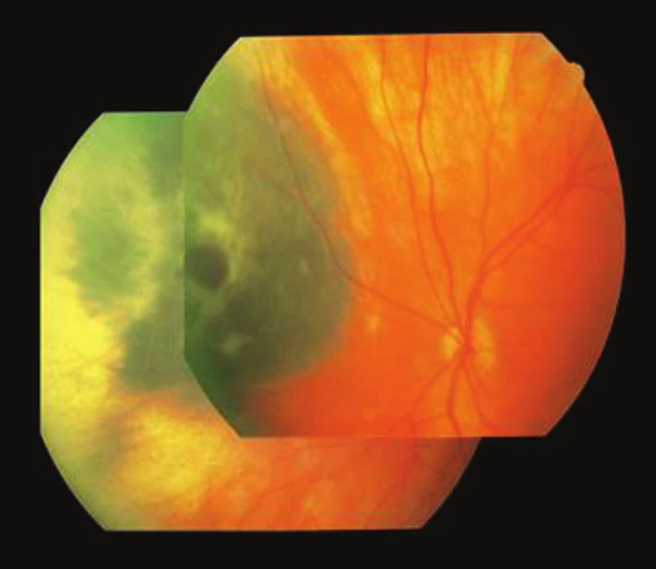 Pacient 2. Nazálne lokalizovaný MMCH v čase stanovenia diagnózy, ľavé oko