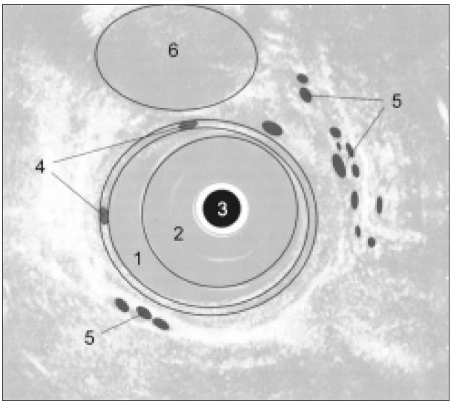 Schéma EUS obrazu jícnu: 1. lumen jícnu, 2. balonek endosonografu, 3. endosonografická sonda, 4. intramurální varixy, 5. paraezofageální varixy, 6. aorta.