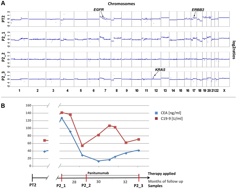 Appearance of <i>KRAS</i> amplification after 6 months of panitumumab therapy in patient #2.