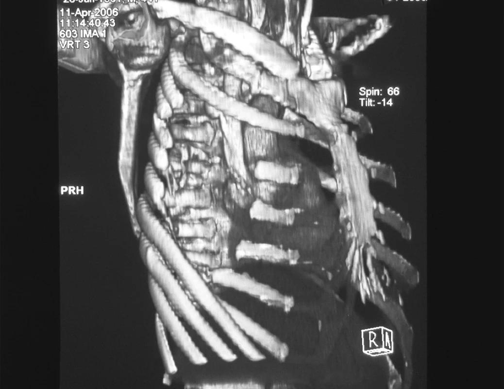 CT obraz 3D rekonštrukcie, stav po torakoplastike
Fig. 5. A CT view of the 3D reconstruction, thoracoplasty completed
