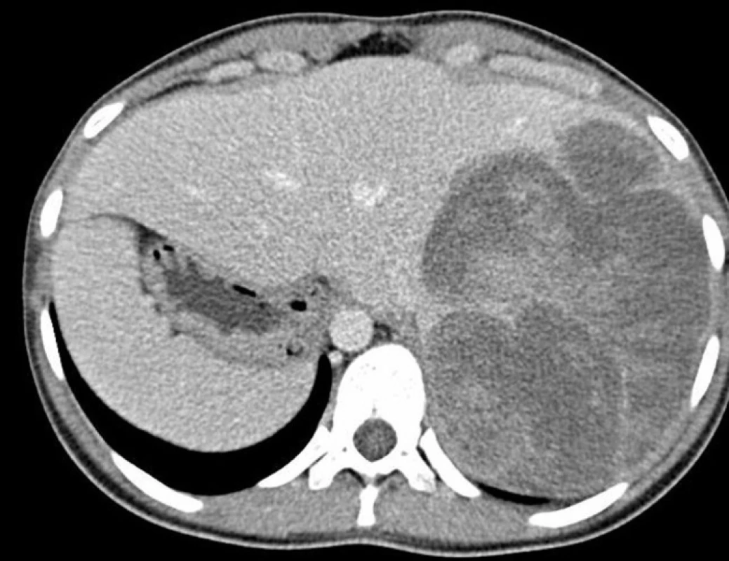 Detekcia veľkého nádoru v pravom laloku pečene pomocou počítačovej tomografie