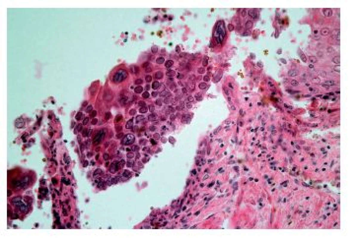 Herpetická ezofagitida. Diagnosticky nejdůležitějšími znaky jsou obrovské vícejaderné buňky (modrá šipka) a intranukleární inkluze Cowdry A (zelené šipky) (HE, 400x).