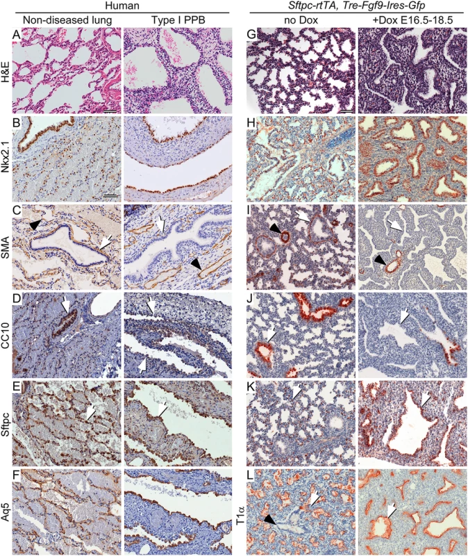 Type I PPB and induced late gestation expression of epithelial FGF9 in mice have similar histopathology and cell differentiation.