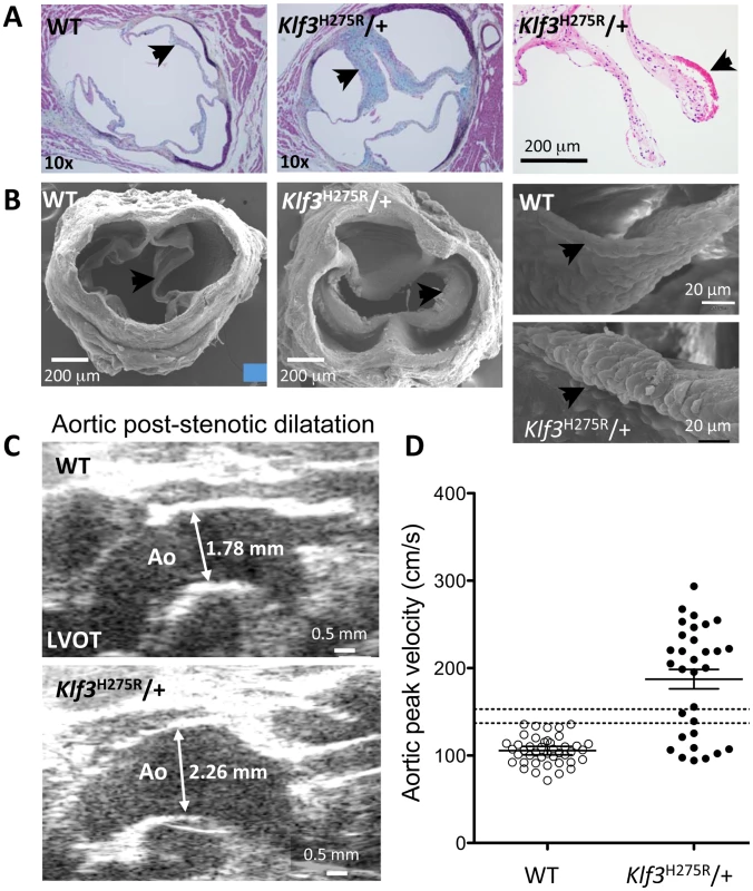 Morphological evidence for aortic valvular stenosis in <i>Klf3</i><sup>H275R</sup>/+ mice.