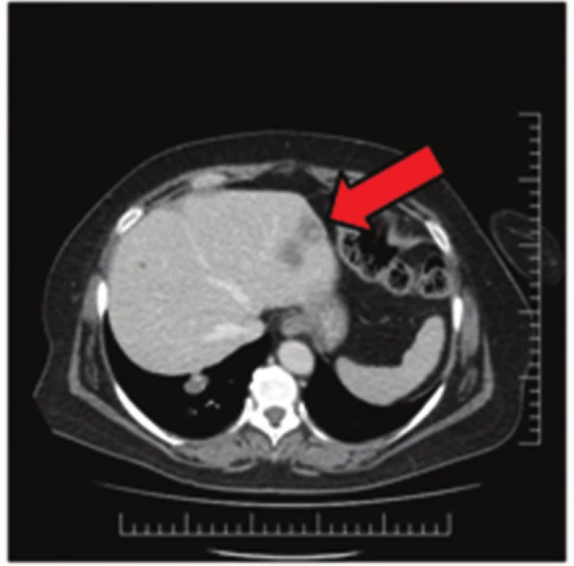 Jaterní metastázy na CT snímku
Fig. 1: Liver metastases on CT scan