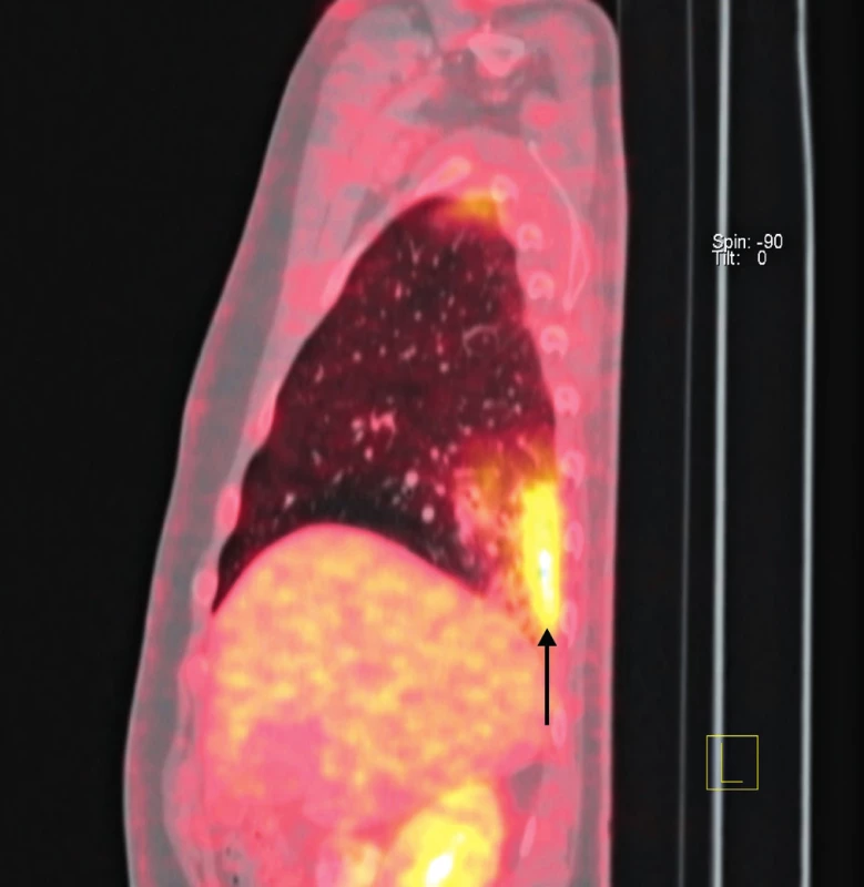 PET/CT hrudníku s akumulací FDG v nepravidelných infiltrátech obou plicních křídel.