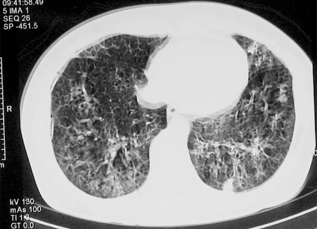 Známky alveolitidy s maximem v dolních plicních lalocích dorzálně