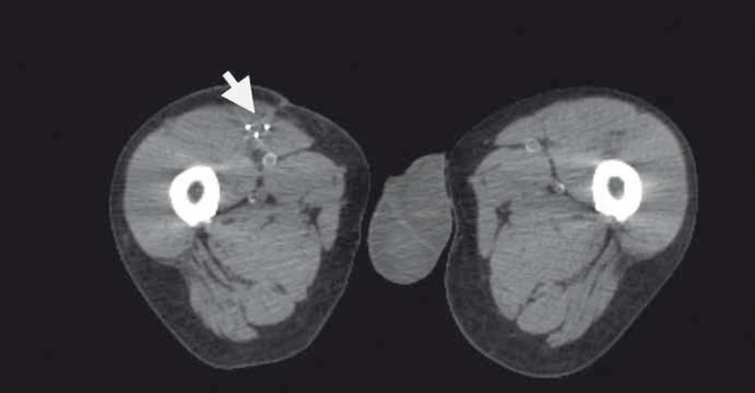 Plánovací CT s třemi aplikátory brachyterapie v resekční dutině (zrcadlové zobrazení).