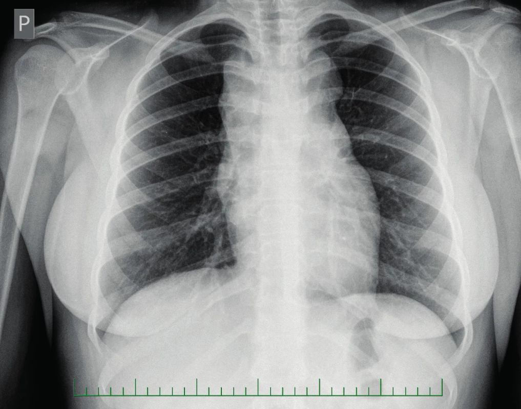 Rtg hrudníku – rozšířené horní mediastinum.
Fig. 1. Chest X-ray – widened superior mediastinum.