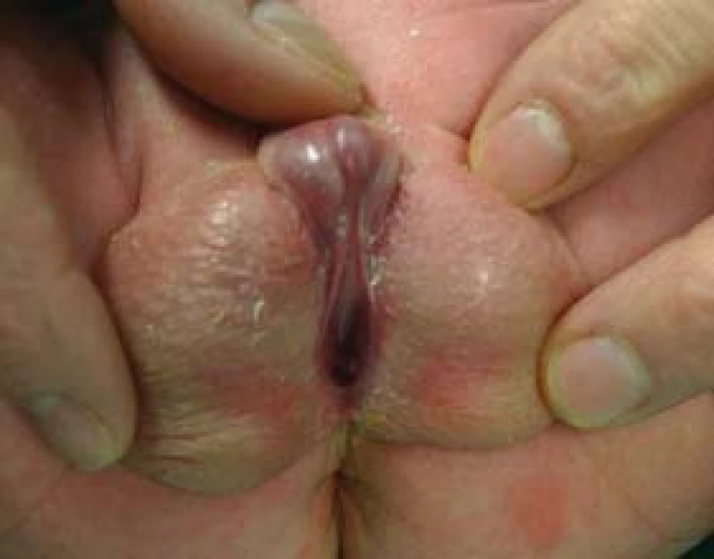 Obraz penoskrotální hypospadie - ústí uloženo na rozštěpeném šourku.
