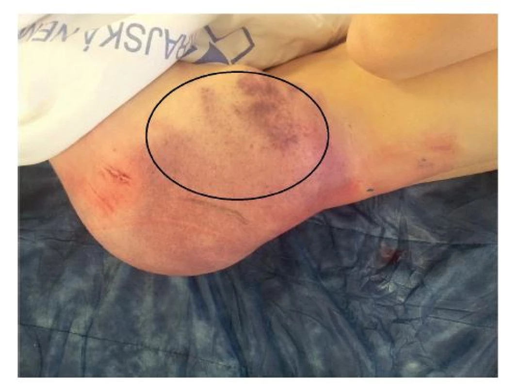 Obr. 1: Rozsáhlá podlitina (“cucflek“) v oblasti hýždě s elastickou rezistencí vlevo
Fig. 1: Large sufusion (“lovebite“) of gluteal area with elastic swelling
