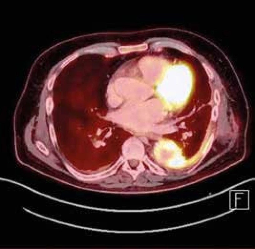 PET/CT – zánětlivá kolekce v oblasti cévní protézy hrudní aorty šířící se do levé pohrudniční dutiny