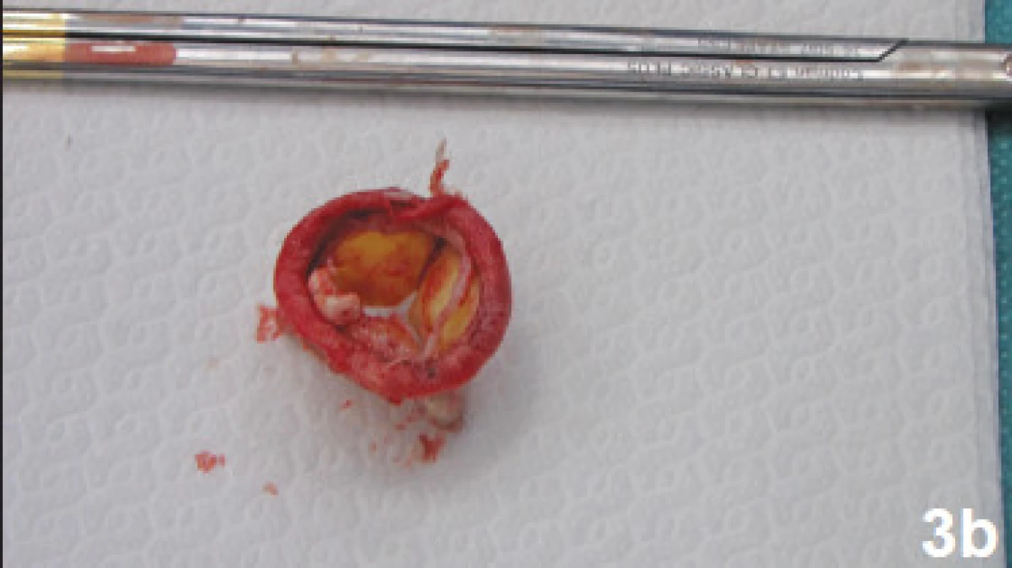 Explantovaná bioprotéza z bovinního perikardu
3a - pohled z aortální strany na odstraněnou aortální náhradu s povlakem křehkých vegetací na ztluštělém cípu
3b - pohled z komorové strany s prořízlým stehem s teflonovou podložkou a povlakem vegetací na cípu