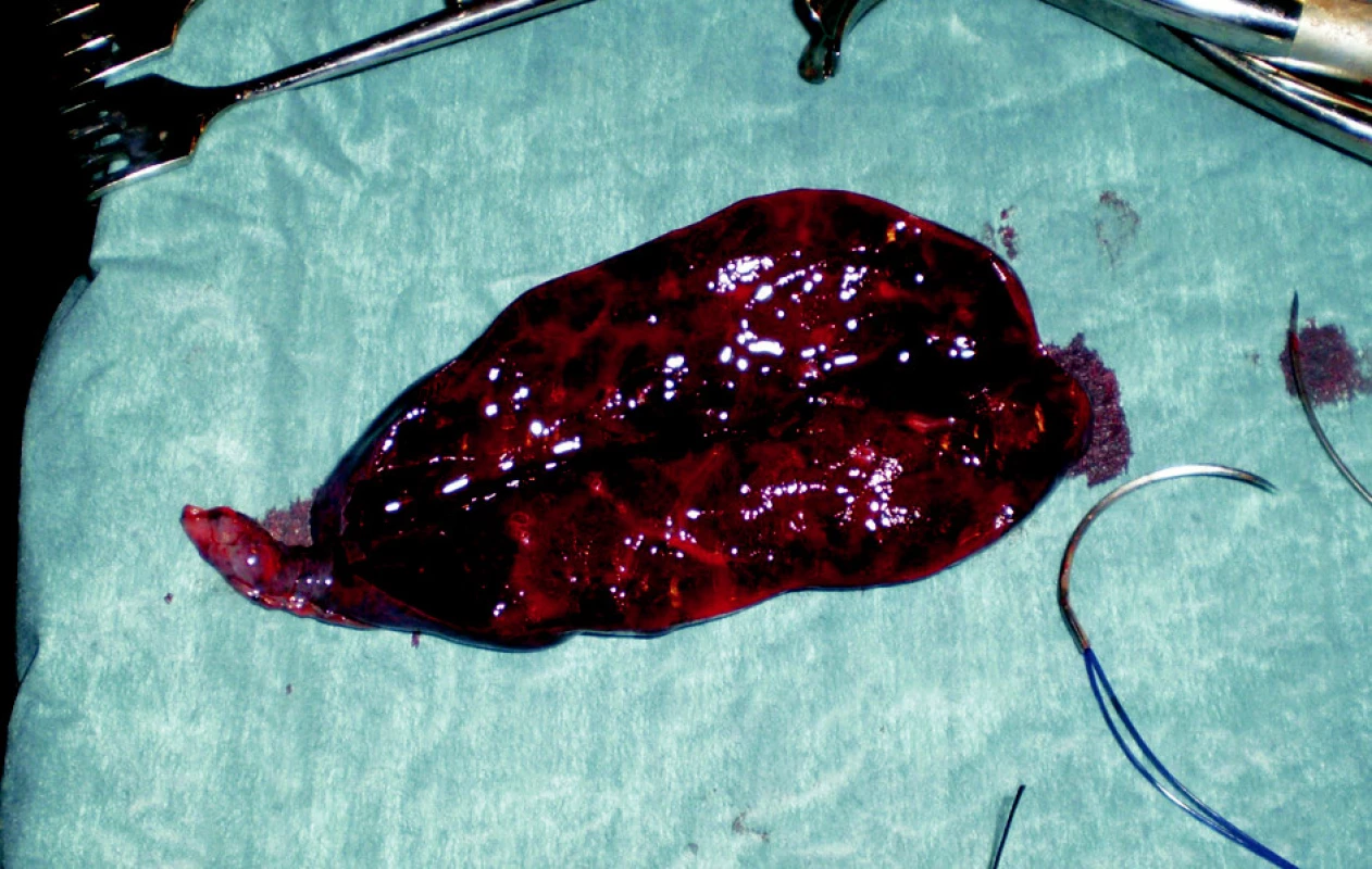 Resekát postižené části levé plíce
Fig. 4. Resected part of the affected left lung