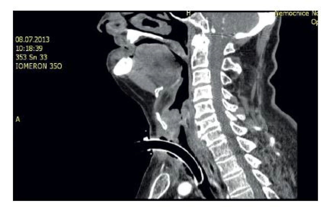 Předoperační CT vyšetření, sagitální řez.