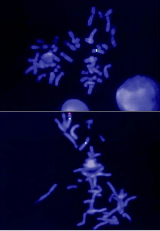 Molekulárně cytogenetická analýza mikrodelece chromozomu Xp22.3 v lokusu STS metodou FISH. 
Pro vyšetření X-vázané ichtyózy má význam především sonda, která hybridizuje s lokusem STS, jehož delece je za vznik choroby zodpovědná. Sonda je dlouhá 220 kb a značena fluorescenčním barvivem Spectrum Orange (červený signál). Mikrodelece kritického regionu se projeví absencí signálu v oblasti Xp22.3. Při hybridizaci je současně každý chromozom X označen další (tzv. kontrolní) sondou, která slouží pouze k detekci přítomnosti chromozomu X, popř. k vyloučení některých strukturních přestaveb tohoto chromozomu (zelený signál). A) Výsledek vyšetření probanda (červený signál na chromozomu X chybí). B) Výsledek vyšetření matky probanda (červený signál je přítomen pouze na jednom chromozomu X, druhý chromozom X je deletován)