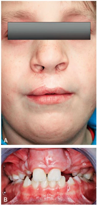 A, B. Face of the patient and teeth six months after surgical repositioning of premaxilla