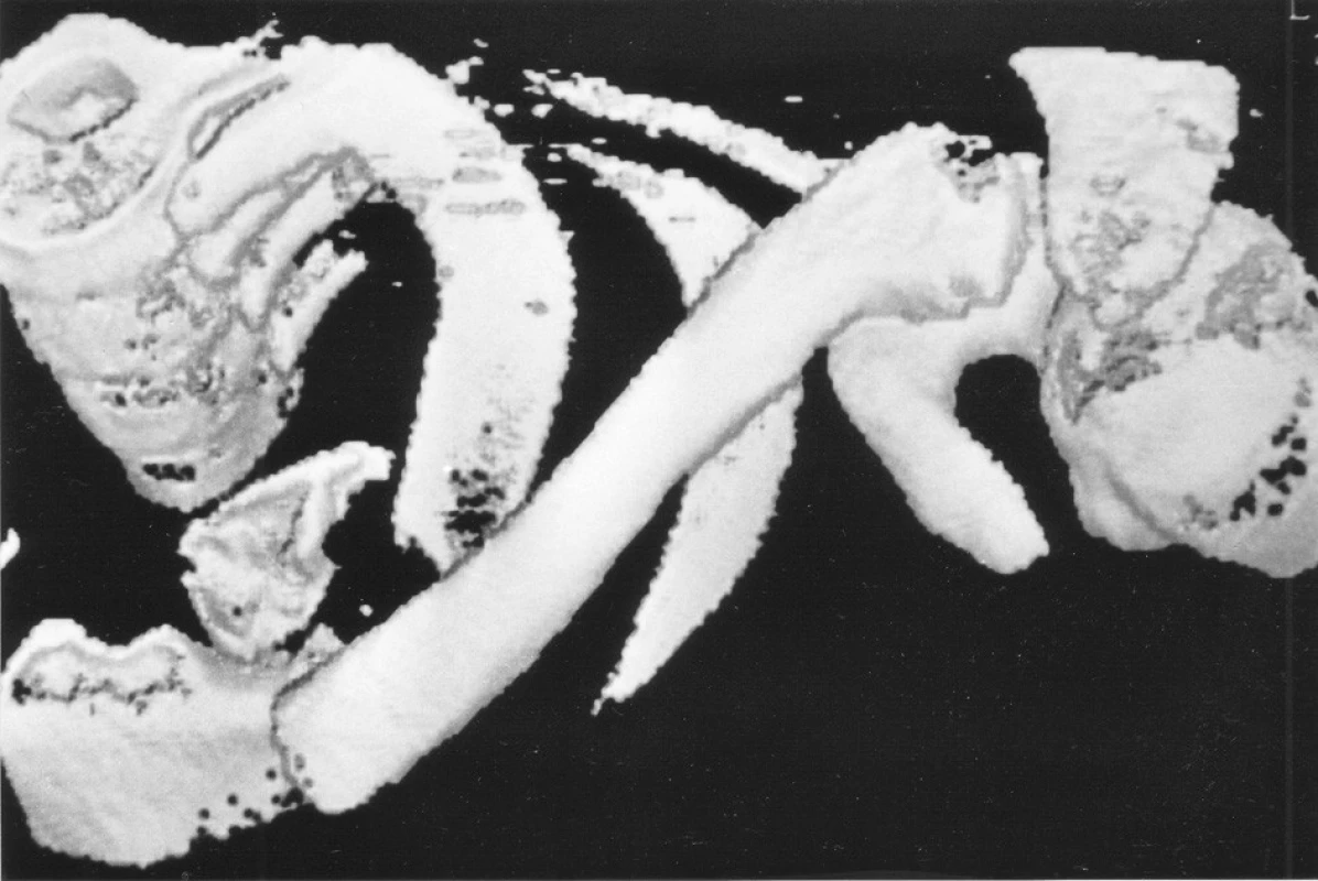 3D CT rekonstrukce šikmé extraartikulární zlomeniny mediálního klíčku vlevo
Fig. 4. 3D CT reconstruction of the oblique extra-articular fracture of the medial end of the left clavicle