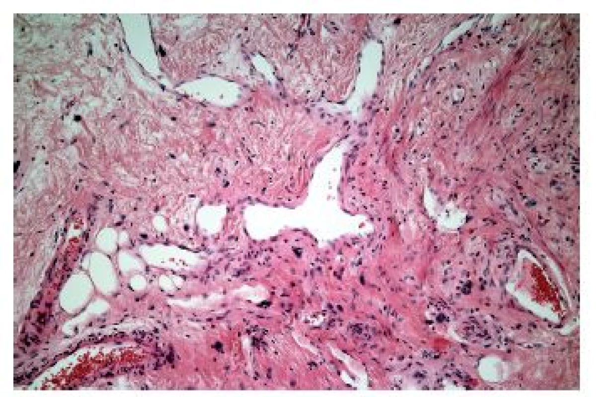 Radiační ezofagitida. Vaskulární ektázie a atypické fibroblasty ve fibrózně ztluštělé proprii by měly vzbudit podezření na postaktinické změny (HE, 600x).