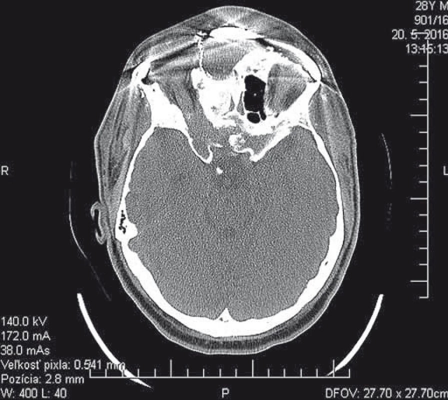 Pooperačné CT vyšetrenie (axiálny rez), rekonštrukcia v oblasti lebkovej bázy a etmoidov.
Fig. 2. Postoperative CT scan (axial view), reconstruction of radix nasi area and the orbital margining modelled using titanium mesh.