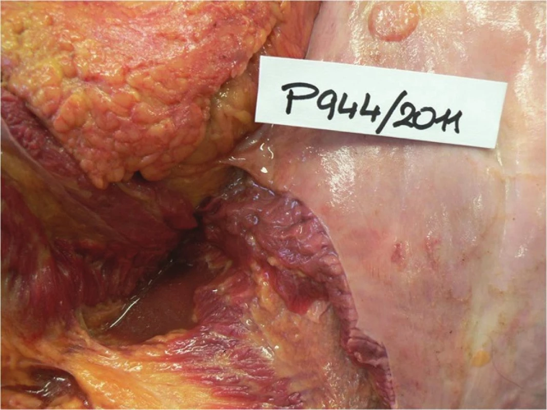 Perforační otvor na žaludku
Fig. 1: Point of gastric perforation