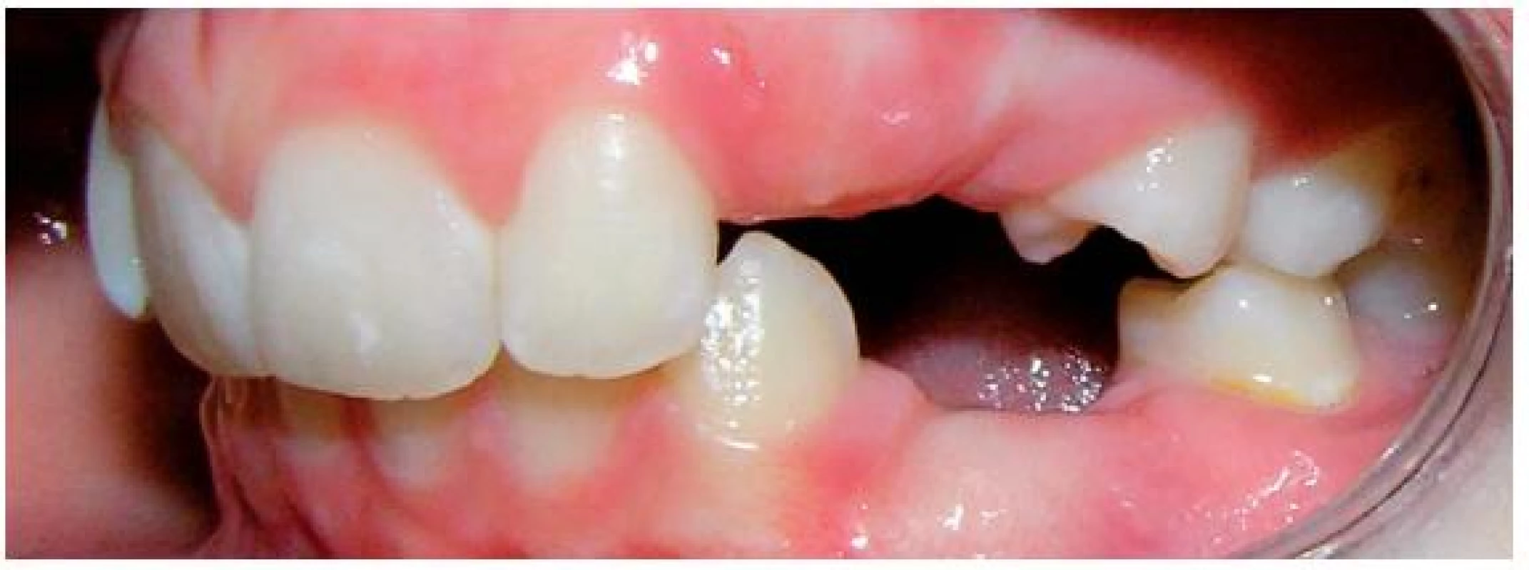 Chrup zleva po extrakcích stálých zubů