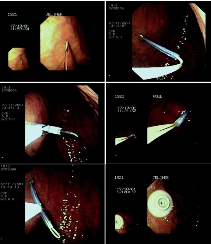 a-f. Zavádění perkutánní endoskopické gastrostomie metodou „pull“