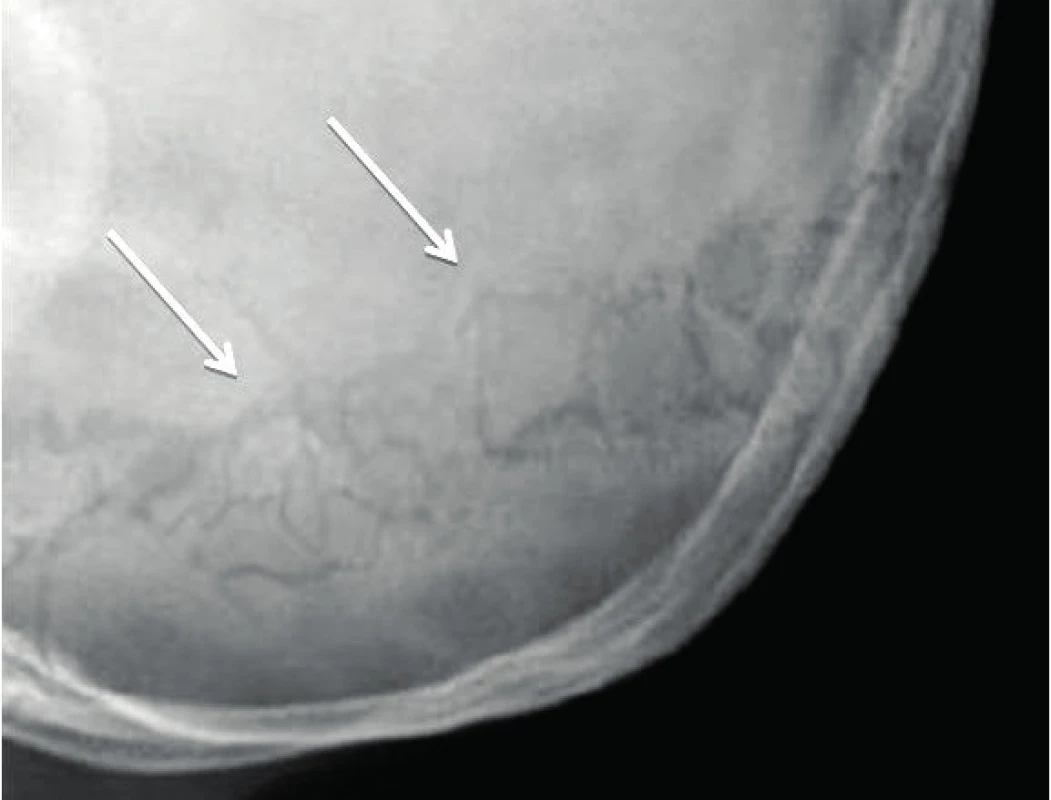 Wormiánské kůstky na snímku lbi.
Fig. 2. Wormian bones on skull X-ray picture.