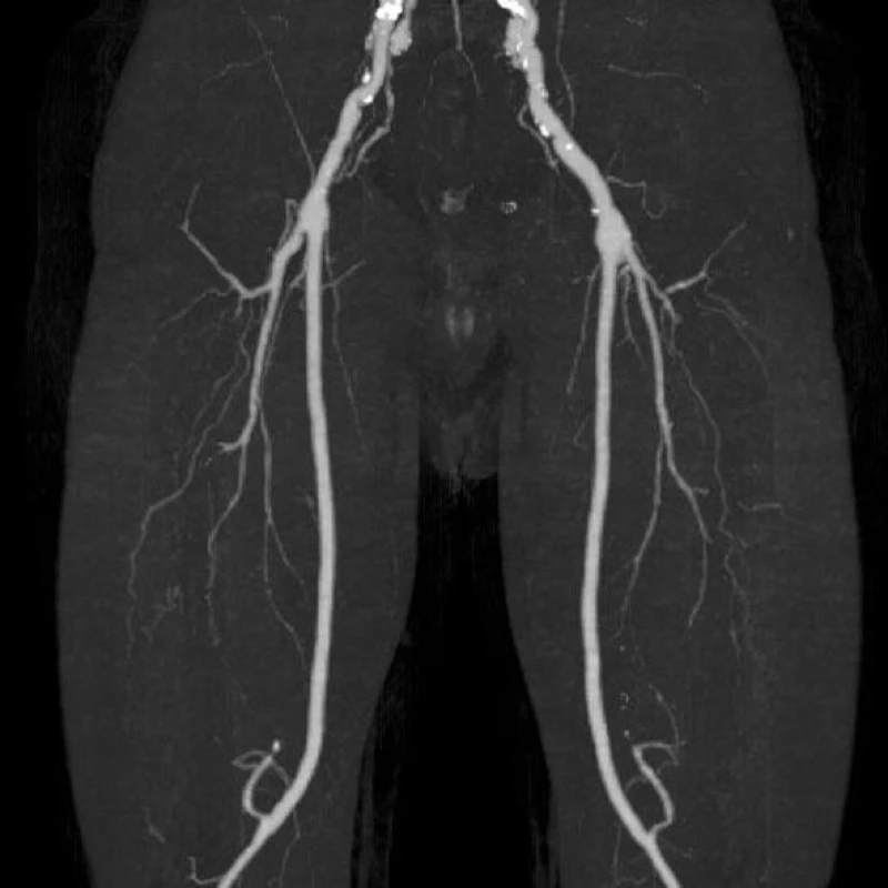 CT AG dolních končetin po půl roce od infektu FP bypassu
Fig. 5: CT angiogram of the lower limbs after 6 months following femoropopliteal bypass infection