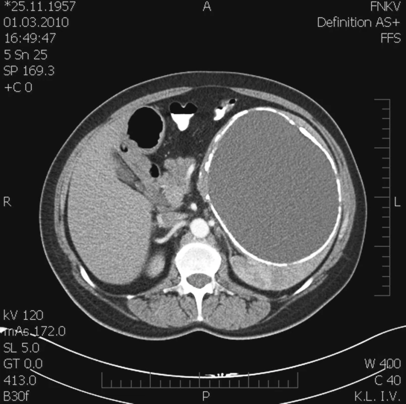 Poúrazová pseudocysta sleziny v CT scanu – transverzální řez
Fig. 1. Post-traumatic pseudocyst of the spleen on CT scantransverse section