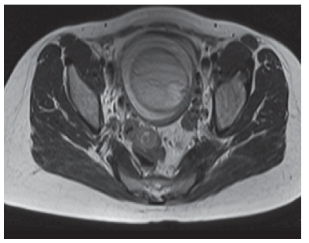Axial MRI of the abdomen/pelvis showing a single intrauterine foetus and sigmoid colon tumour