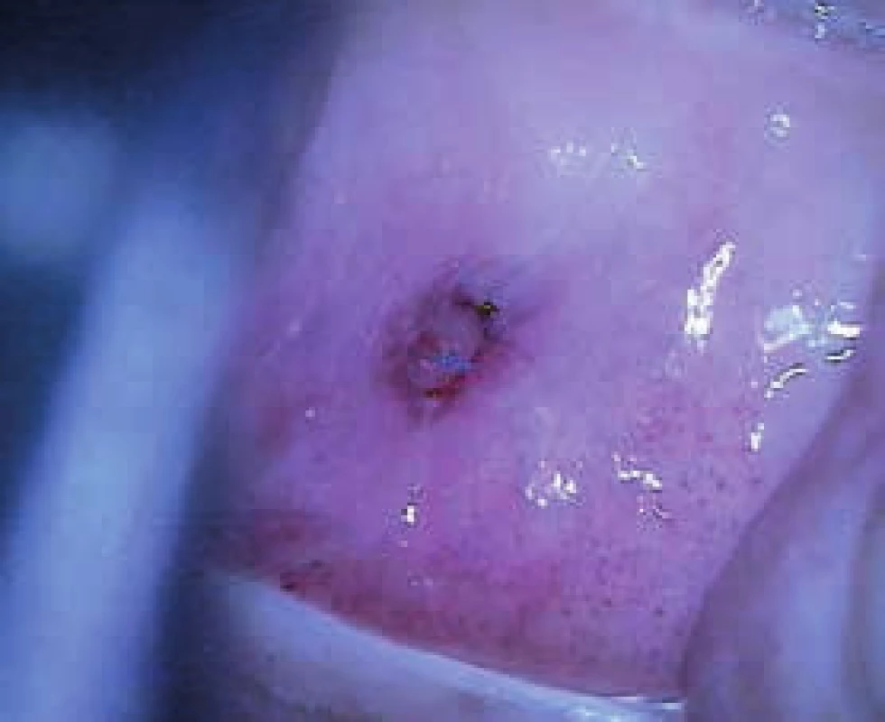 Kazuistika 2. Kolposkopicky nehodnotitelná TZ, v hrdle děložním drobný polyp velikosti 3 × 3 mm, atrofie epitelu