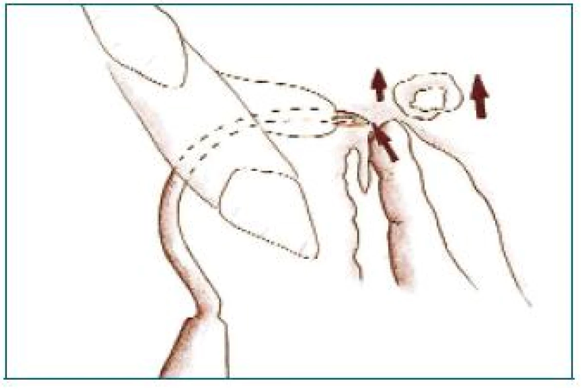 Perforace membrány zavaděčem a chránění hrotu prstem.
