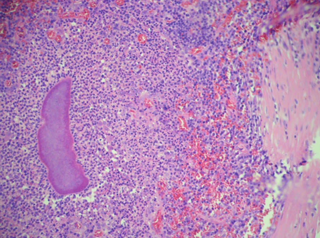 Ovarium - charakteristická drúza v zánětlivém infiltrátu
Fig. 6: The ovary – characteristic sulfur granule in inflammatory infiltration