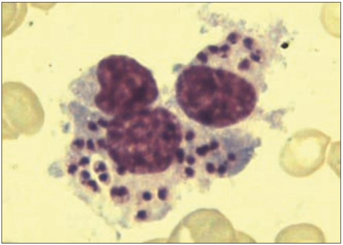 Amastigoty &lt;em&gt;Leishmania sp.&lt;/em&gt; fagocytované makrofágem v kostní dřeni (barvení dle Pappenheima, zvětšeno 1 000krát).